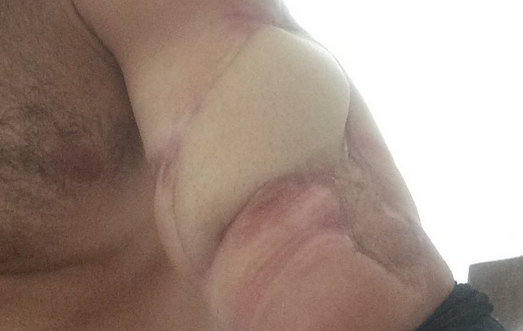 Here’s What Gay Porn Star Cole Money’s Arm Looks Like Now