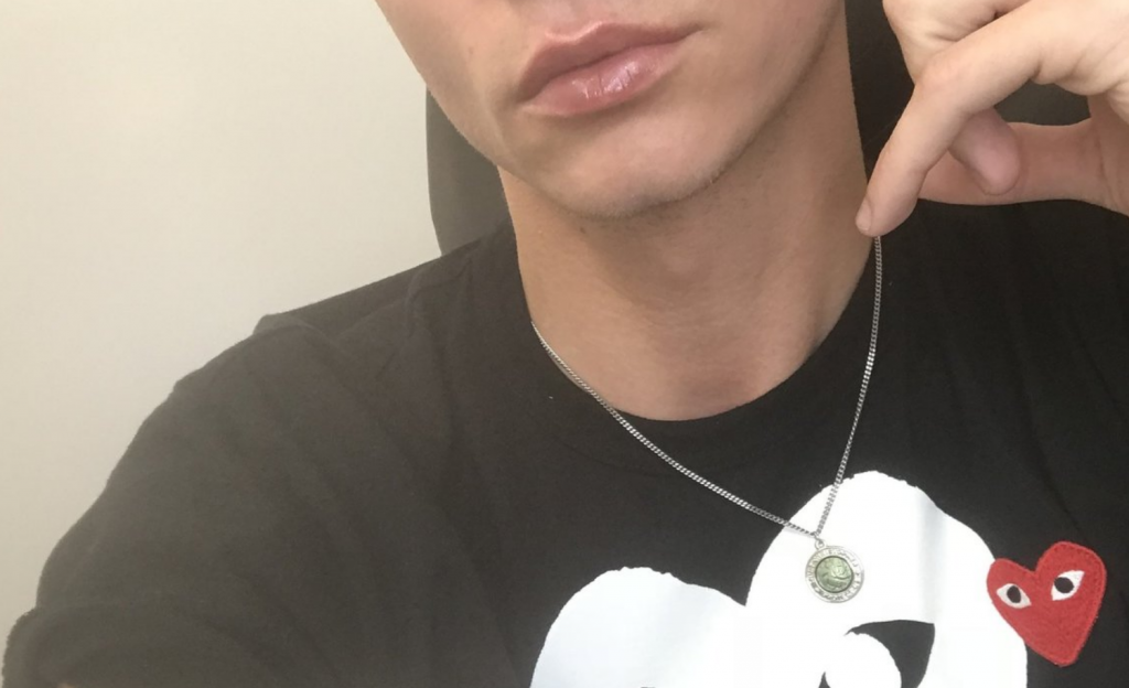 George Alvin Got Lip Injections