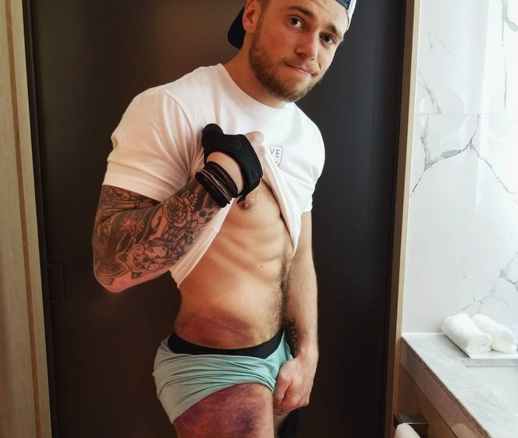 Gus Kenworthy Shares Photo Of Bruised Butt