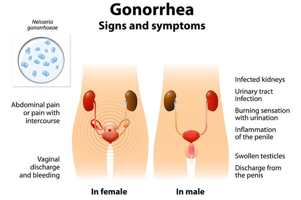 UK Man Has “World’s Worst” Super-Gonorrhea, And Doctors Are Struggling To Cure It