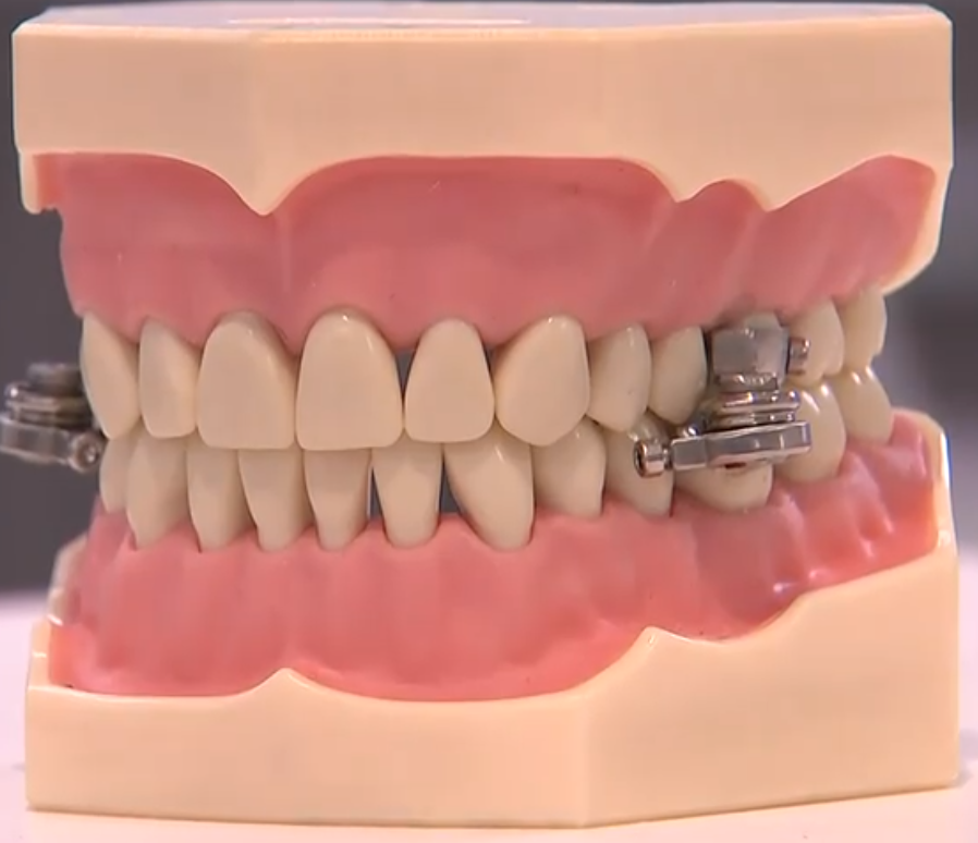Weight Loss Device With Magnetic Locks Blocks Mouths From Opening More Than 2 Millimeters