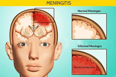 Move Over Monkeypox: Meningitis Outbreak Among Florida Gays Kills 7