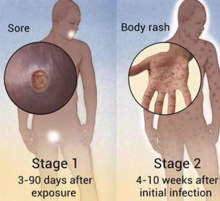 Syphilis Rates Skyrocket, With The Most New Infections In Over 70 Years