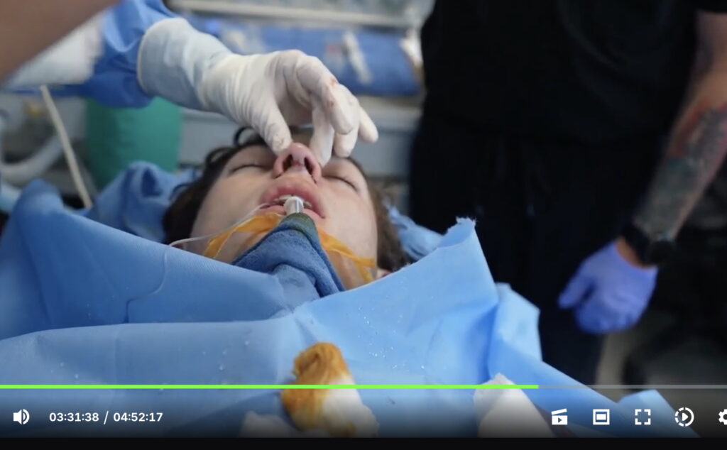 Looksmaxxer Clavicular Livestreams His Nose Job Surgery